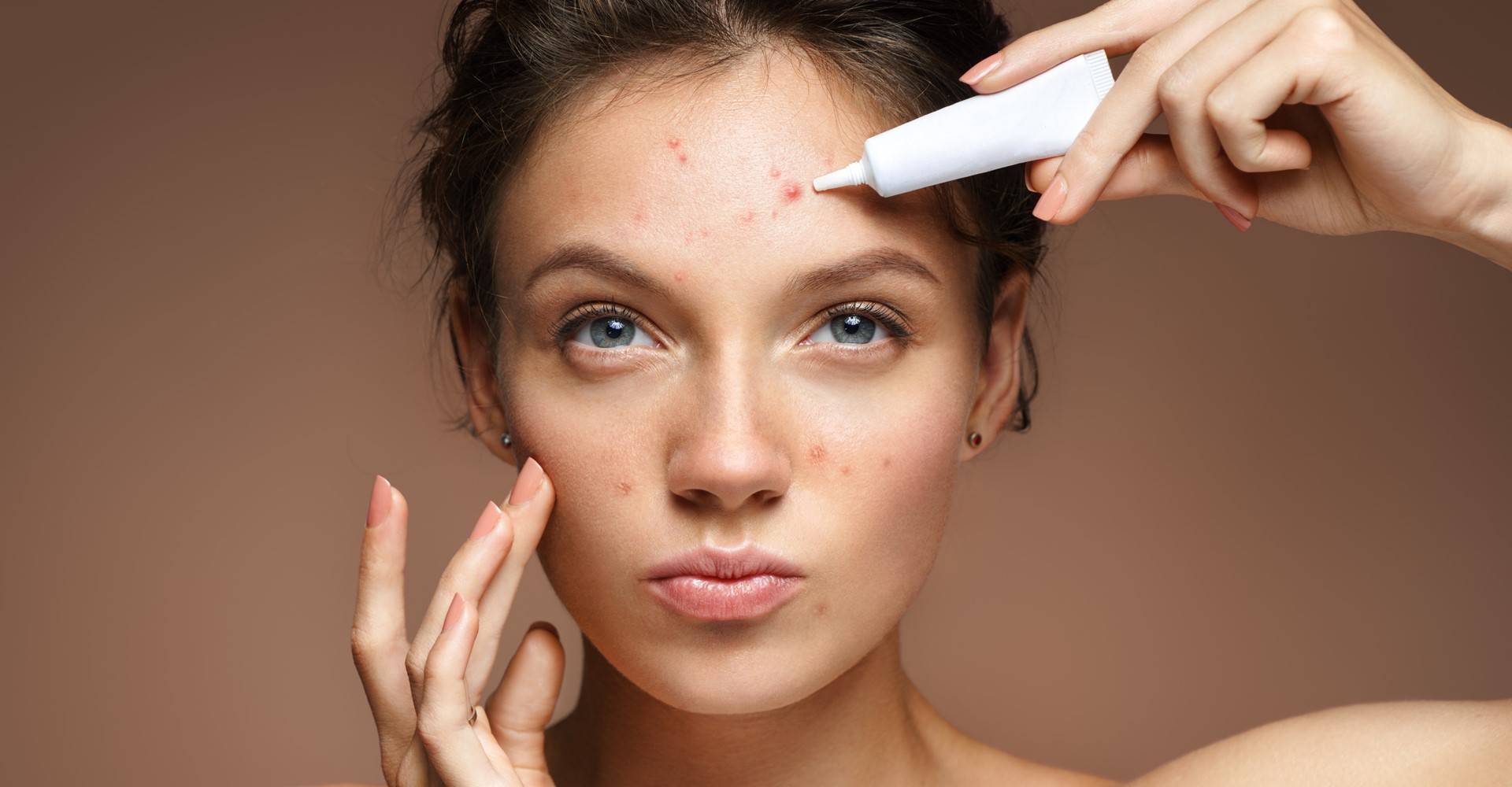 5 Dicas de Como Cobrir Espinhas e Manchas com Maquiagem