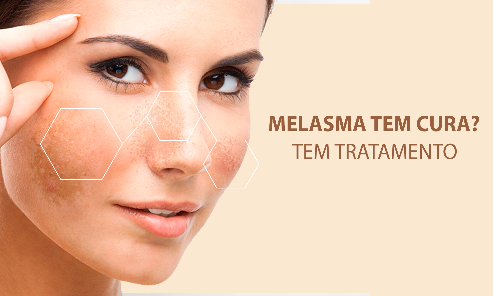 Como tratar melasma